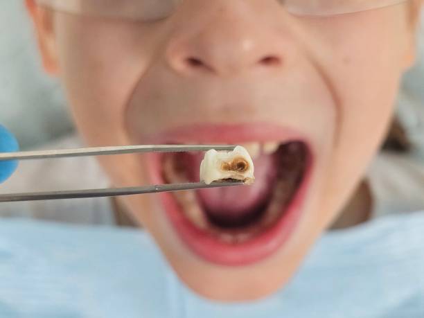 Best Emergency Dentist for Lost Fillings or Crowns in Fillmore, CA